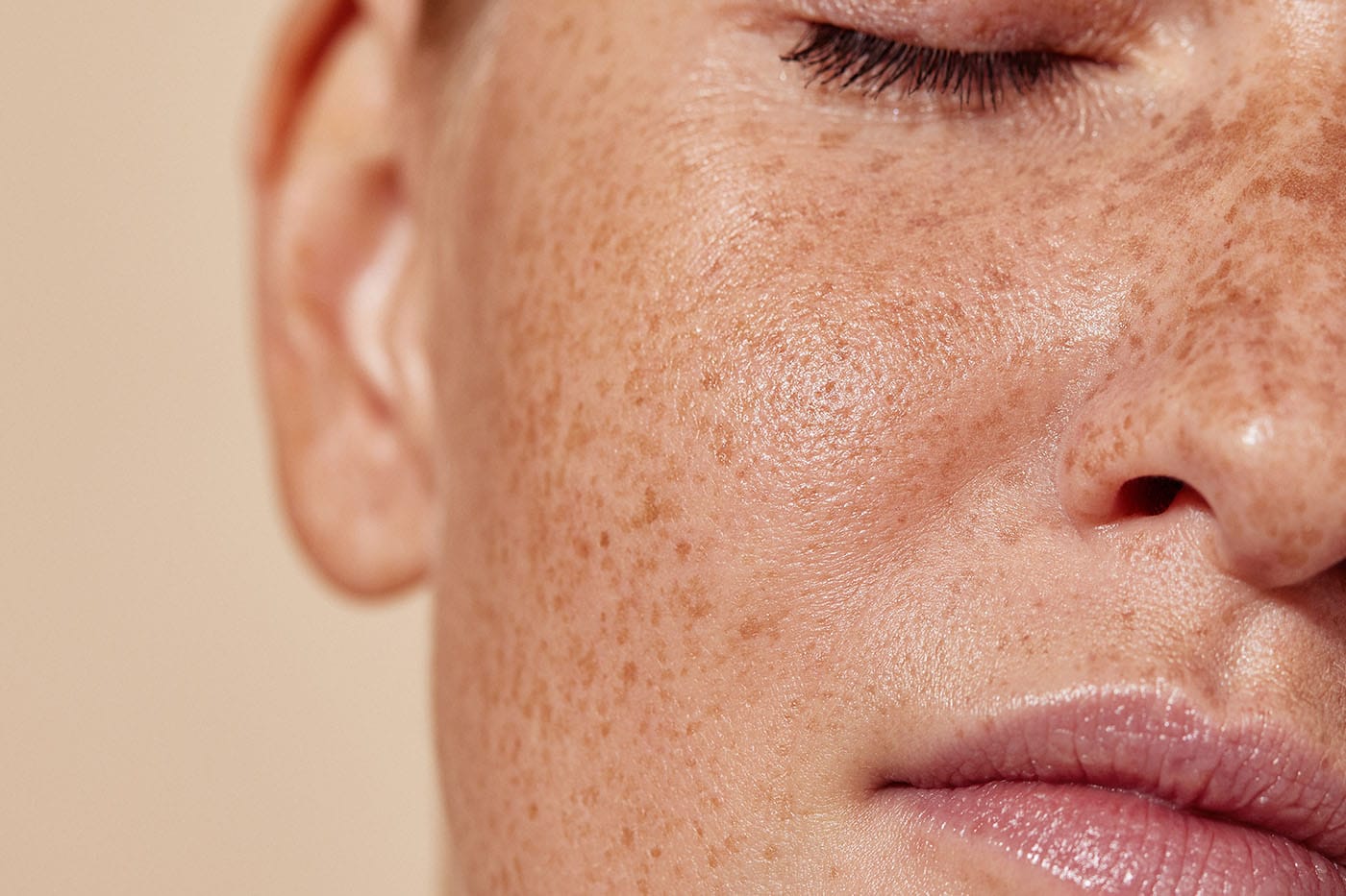 Prirodna krema protiv hiperpigmentacije i ožiljaka: snažna depigmentacija uz tratinčicu i smilje